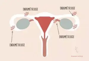 endométriose