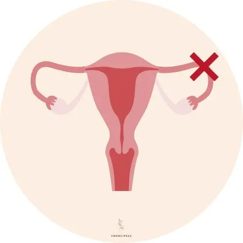 causes obstruction trompes de fallope