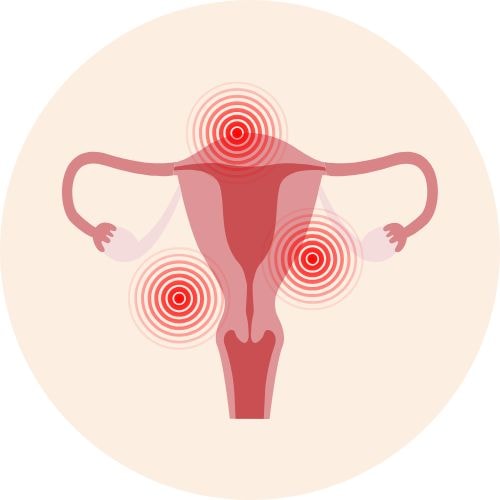 inflammation utérus