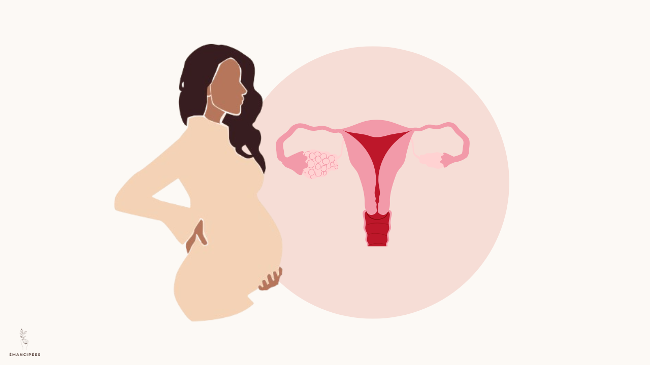 SOPK fertilité